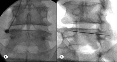 Figure 1 from Comparison of effectiveness of facet joint injection and radiofrequency ...