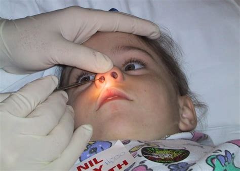 Nasal foreign body • LITFL • Clinical Cases Paediatric