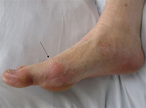 Gout (Uric Acid Crystals in Joints) and Gouty Arthritis Attacks ...