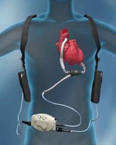 LVAD Procedure In Singapore | Apex Heart Clinic