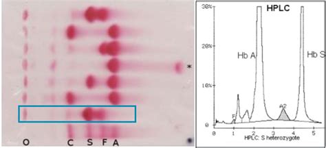 Microangiopathy Sickle Cell Lab