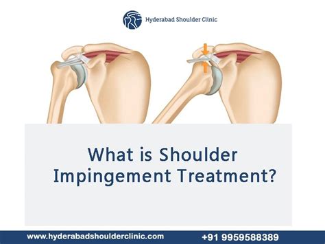 What is Shoulder Impingement Treatment? - shoulder clinic Hyderabad