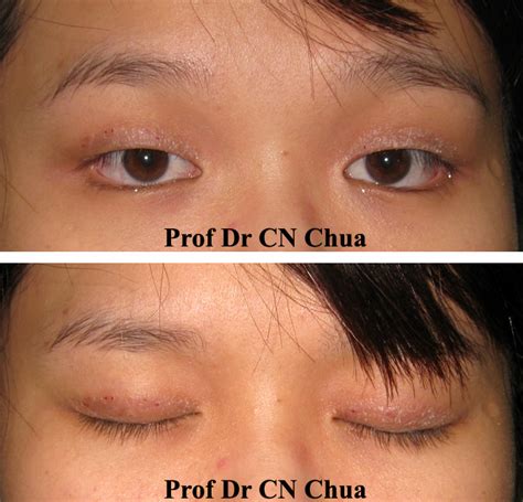 Eyelid Surgery by Prof Dr CN CHUA 蔡鐘能: Allergy to Tapes for Double Eyelids