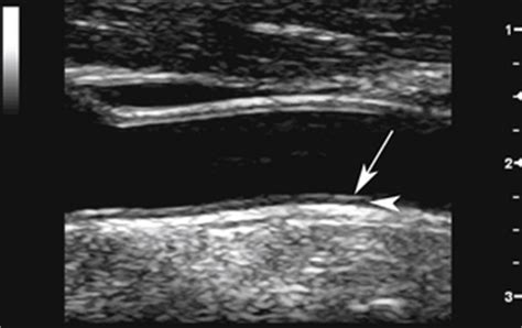 Normal Findings and Technical Aspects of Carotid Sonography | Radiology Key