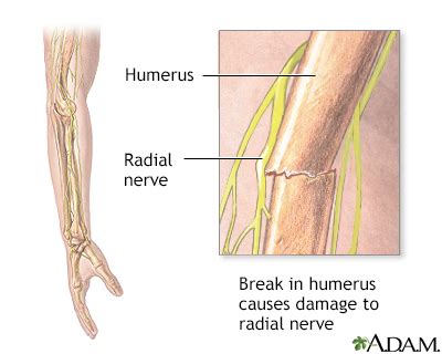 Radial Nerve Entrapment