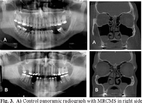 [PDF] Three-dimensional images contribute to the diagnosis of mucous retention cyst in maxillary ...