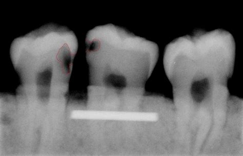 Designing of a Computer Software for Detection of Approximal Caries in ...