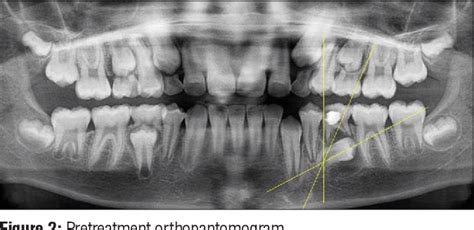 Dilaceration of tooth | Semantic Scholar