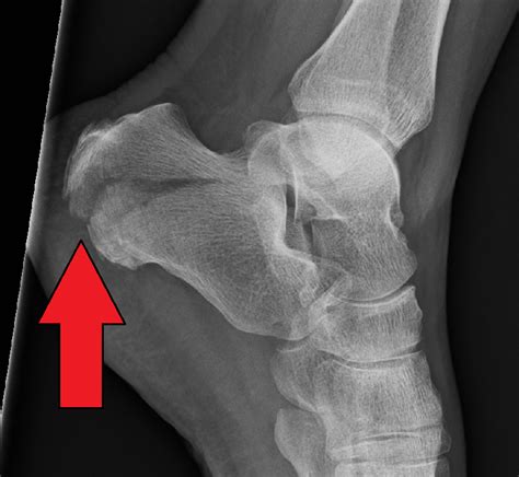 Calcaneus Fracture