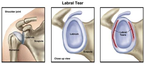 Shoulder Labral Tear Physical Therapy Treatment-Mangiarelli Rehabilitation