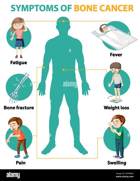 Medical infographic of bone cancer symptoms illustration Stock Vector Image & Art - Alamy