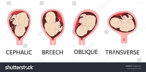 Vertex Position Fetal Position In