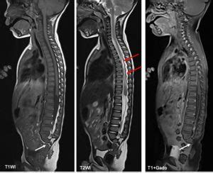 Sacral agenesis – Radiology Cases