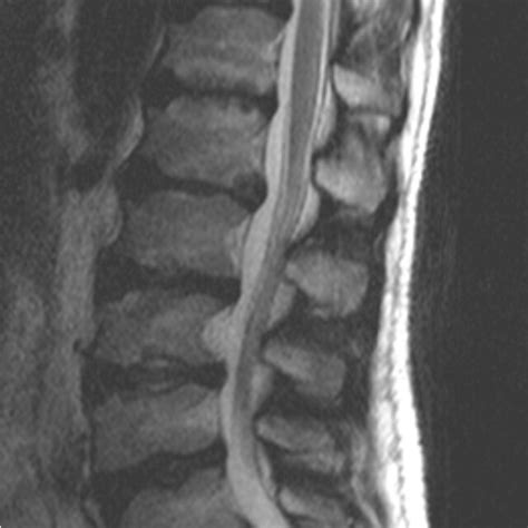 a -MRI spine: dysostosis multiplex in Case 1 (age 20); b-Dysostosis ...