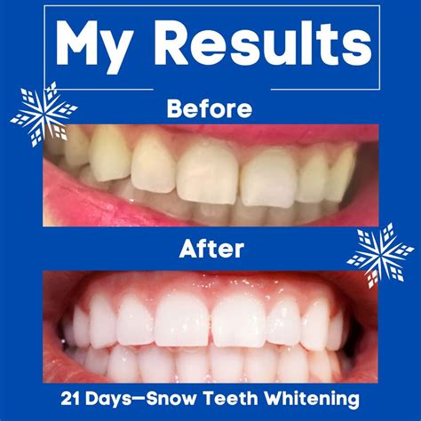 Snow Teeth Whitening review + everything you need to know before buying