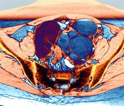 Endometriosis And Ovarian Cyst Photograph by Zephyr/science Photo ...