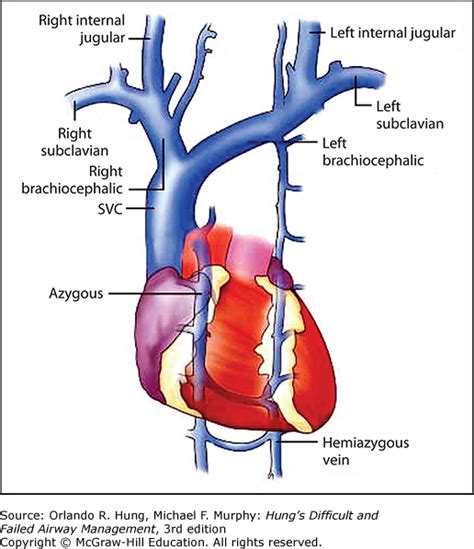 Airway Management of a Patient with Superior Vena Cava Obstruction Syndrome | Anesthesia Key