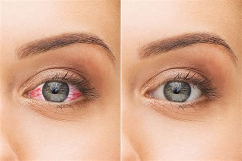 Dry Eye Syndrome: 10 Home Remedies To Cure It - YeyeLife