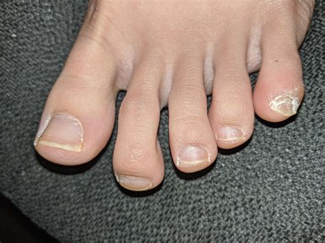 Toenail fungus? Always thought my toes were just gross because my pinky ...