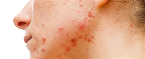 Researchers Might Have Figured Out Why Bacteria Only Causes Acne in Some People : ScienceAlert