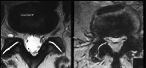 Facet joint disease. Facet joint osteoarthrosis in and facet joint ...