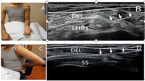 Subdeltoid Bursitis Ultrasound