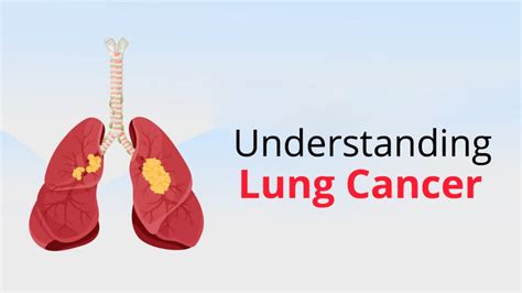 Lung Cancer Causes