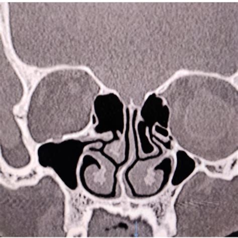 Coronal CT scan showing concha bullosa on the left middle turbinate and ...