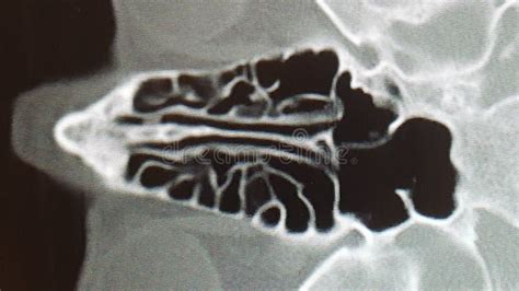 CT Scan of the Ethmoid Sinus Air Cells Stock Photo - Image of nasal, isolated: 213823628