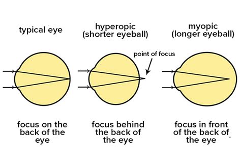 What Is the Definition of High Myopia (Severe Nearsightedness)?