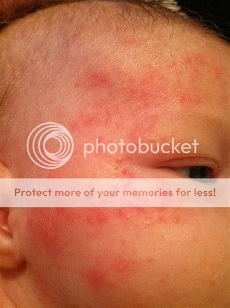 Cradle cap face rash or something else?? Pics | BabyCenter