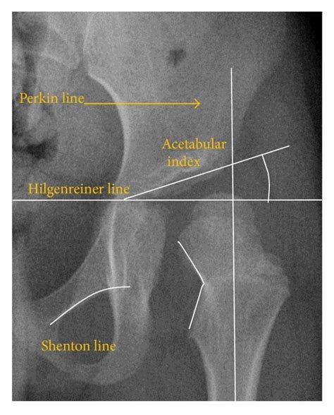 Sagittal T1 weighted images showing anterosuperior labral tear (a) and... | Download Scientific ...