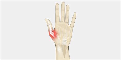 Sprained Thumb - The Complete Injury Guide - Vive Health