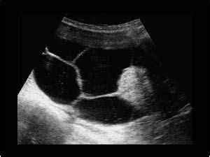 Multiloculated ovarian cyst and intracystic mass | Cysts, Ovarian cyst ...