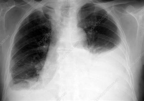 Bilateral Pleural Effusion X Ray