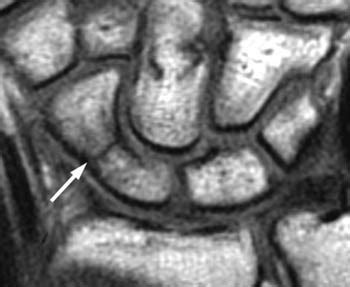 MRI imaging Techniques: Scaphoid fracture MRI imaging