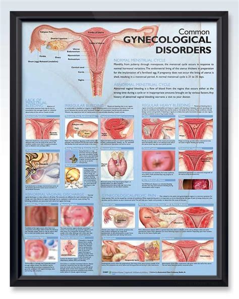 Gynecological Disorder Exam-Room Anatomy Posters – ClinicalPosters