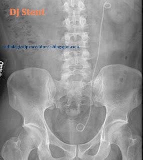 Radiological Procedures: DJ Stenting