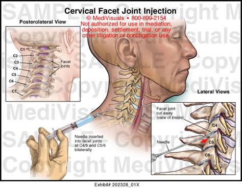 Cervical Facet Joint Injection Medical Illustration Medivisuals