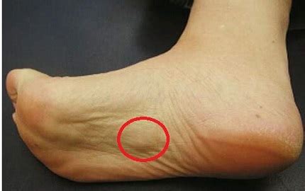 Top 16 painful lump on bottom of foot under skin 2022