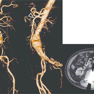 Pre-procedural images: CT images show infrarenal AAA (5.0 cm). There is... | Download Scientific ...