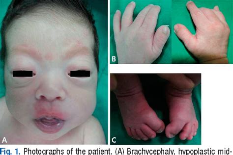 Figure 1 from A case of Pfeiffer syndrome with c833_834GC>TG (Cys278Leu ...