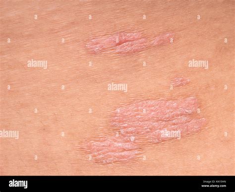 Psoriasis skin. Psoriasis is an autoimmune disease that affects the skin cause skin inflammation ...