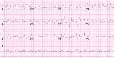 Dr. Smith's ECG Blog: Hyperkalemia and ST Segment Elevation, Post 1