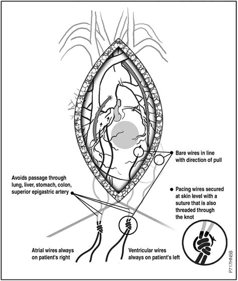 Minimizing Complications from Temporary Epicardial Pacing Wires after Cardiac Surgery | Advisory