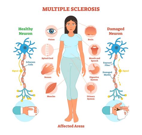 Multiple Sclerosis (MS): Causes, Treatment, Disability