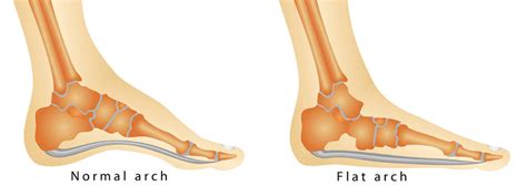 Fallen Arches: Symptoms, Causes, Exercises, Treatment, Diagnosis