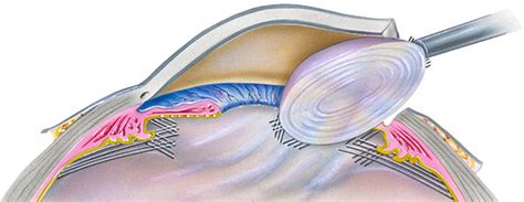 Cataract lens replacement surgery offers you a superior quality of vision.