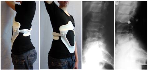 Patient with lumbar Scheuermann in the physio-logic™ brace. Improvement... | Download Scientific ...