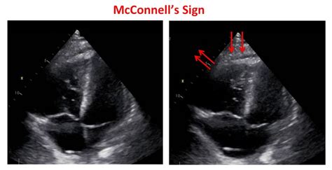 Echocardiography in Pulmonary Embolism...the Clot Thickens Cardioserv